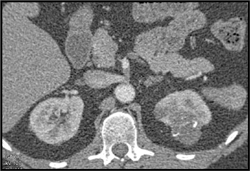 Cystic Renal Cell Carcinoma - CTisus CT Scan