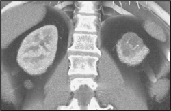 Cystic Renal Cell Carcinoma - CTisus CT Scan