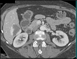 Clot in Left Renal Vein - CTisus CT Scan