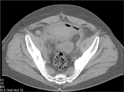 Prevesical Abscess With Drain - CTisus CT Scan