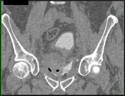 Bladder With Contrast Extravasation - CTisus CT Scan