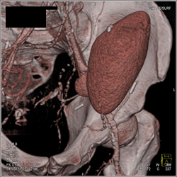 Patent Renal Artery to Transplant Kidney - CTisus CT Scan