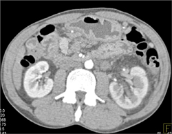 Delayed Perfusion of Left Kidney With Edematous Kidney - CTisus CT Scan