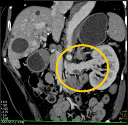 Renal Vein Clot Not Seen on MIP Image - CTisus CT Scan