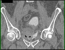 Extravasation of Contrast From the Bladder - CTisus CT Scan