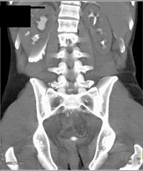 Pyelosinus Extravasation From the Right Kidney - CTisus CT Scan