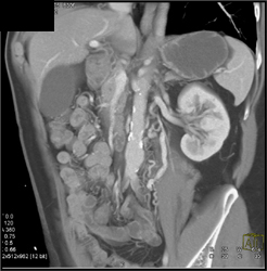 Collaterals Near the Left Gonadal Vein - CTisus CT Scan