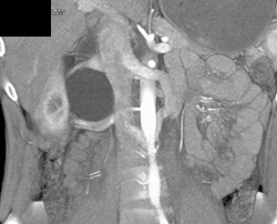 Ureteropelvic Junction (UPJ) Due to Second Renal Artery to the Lower Pole of the Right Kidney - CTisus CT Scan