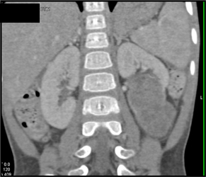 Wilms Tumor - CTisus CT Scan