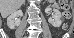 Sequence of Images Showing Poor Perfusion of the Kidneys on Early Phase Imaging Due to Underlying Renal Disease - CTisus CT Scan