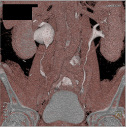 Ureteropelvic Junction (UPJ) of Right Renal Pelvis - CTisus CT Scan