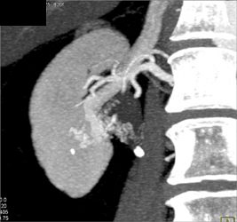 Arteriovenous Malformation (AVM) of the Right Renal Pelvis Which Simulates A Transitional Cell Carcinoma on Excretory Phase Images - CTisus CT Scan