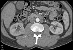 Incidental Renal Cell Carcinoma Found on Workup for Obstructing Stone at Ureterovesical Junction (UVJ) - CTisus CT Scan