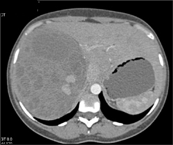 Epithelial Tumor of the Kidney - CTisus CT Scan