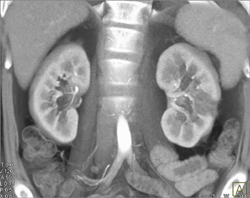 Acute Pyelonephritis - CTisus CT Scan