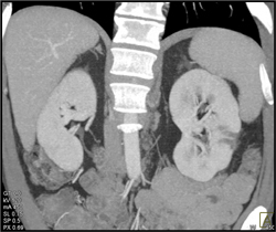 Acute Pyelonephritis - CTisus CT Scan