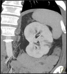 Acute Pyelonephritis - CTisus CT Scan