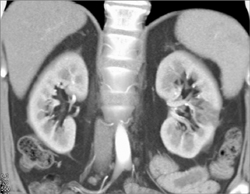 Acute Pyelonephritis - CTisus CT Scan