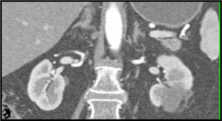 Post Radiofrequency Ablation (RFA) of the Left Kidney - CTisus CT Scan