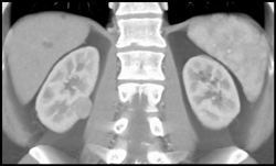 Renal Cell Carcinoma - CTisus CT Scan