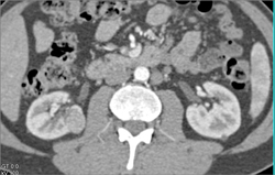 Renal Cell Carcinoma - CTisus CT Scan