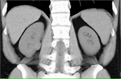 Renal Cell Carcinoma - CTisus CT Scan