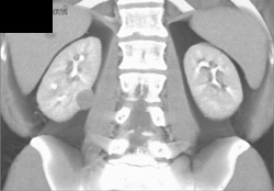 Renal Cell Carcinoma - CTisus CT Scan