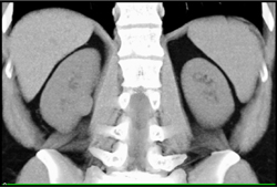 Renal Cell Carcinoma - CTisus CT Scan