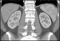 Renal Cell Carcinoma - CTisus CT Scan