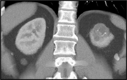 Cystic Renal Cell Carcinoma - CTisus CT Scan