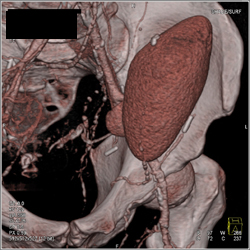 Patent Renal Artery to A Transplant Kidney - CTisus CT Scan