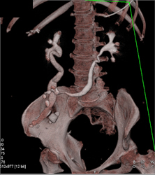 Ct Urogram Defines A Neobladder - CTisus CT Scan