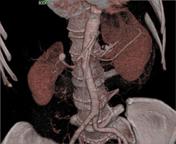 Right Renal Artery - CTisus CT Scan