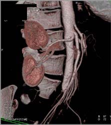 Nice VRT of Renal Arteries and Celiac and SMA - CTisus CT Scan