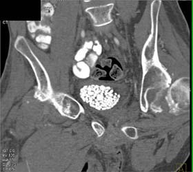 Multiple Bladder Calculi - CTisus CT Scan