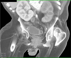 Bladder Cancer and Xanthogranulomatous Pyelonephritis (XGP) - CTisus CT Scan