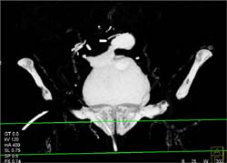 Ct Cystogram With Anastomosis - CTisus CT Scan