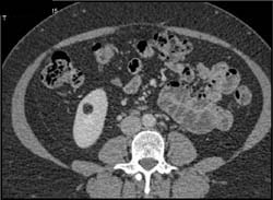 Angiomyolipoma (AML) Right Kidney - CTisus CT Scan