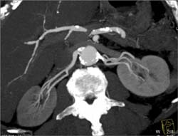 Normal Renal Artery Branching - CTisus CT Scan