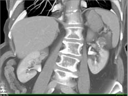 Cystic Renal Cell Carcinoma (RCC) - CTisus CT Scan