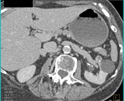 Cystic Renal Cell Carcinoma (RCC) - CTisus CT Scan