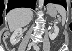 Cystic Renal Cell Carcinoma (RCC) - CTisus CT Scan