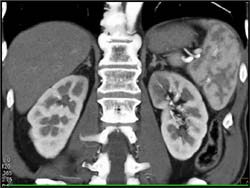 Acute Pyelonephritis With 3D Mapping - CTisus CT Scan