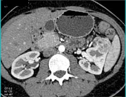 4 Cm Renal Cell Carcinoma (RCC) - CTisus CT Scan