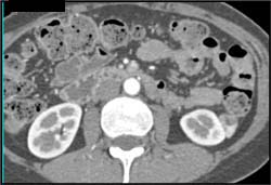 Renal Cell Carcinoma-hard to See on Axial Images But Easy to See With MPR-3D - CTisus CT Scan