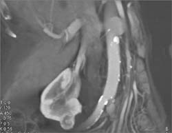 2 Cm Renal Cell Carcinoma (RCC) - CTisus CT Scan