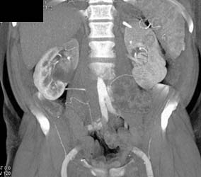 Transitional Cell Carcinoma With Several Renderings - CTisus CT Scan