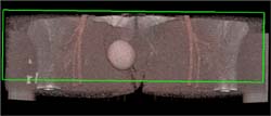 Prosthetic Testicle - CTisus CT Scan