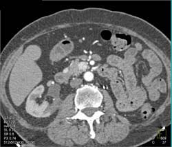 Metastatic Renal Cell Carcinoma (RCC) to Pancreas and Contralateral Kidney - CTisus CT Scan