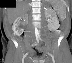 Transitional Cell Cancer (TCC) of Right Kidney - CTisus CT Scan